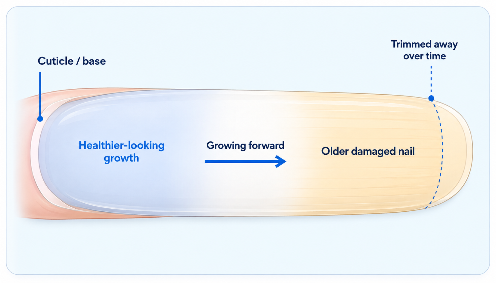 Diagram showing healthier-looking nail growth moving from base to tip