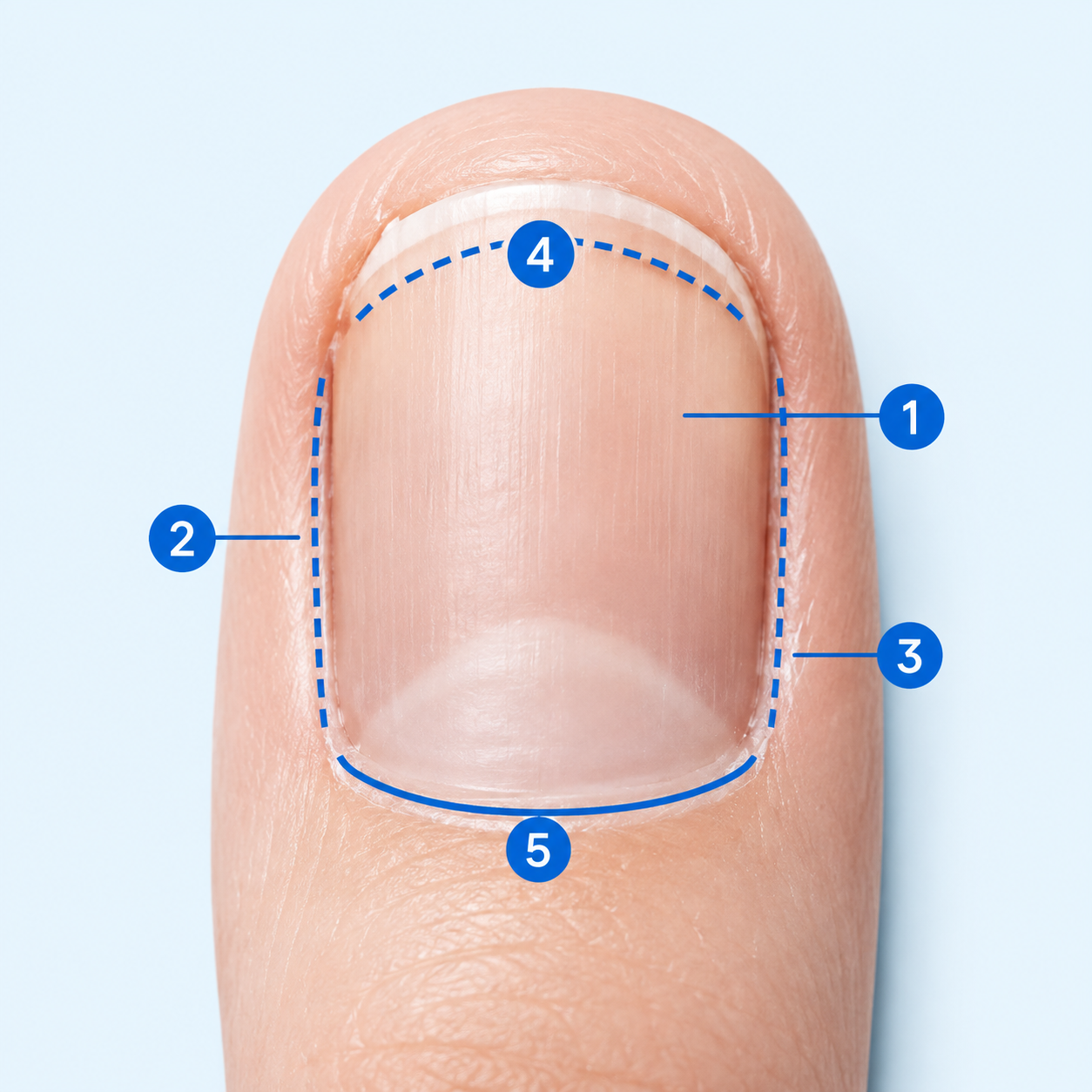 Toenail with numbered markers showing the nail surface, both nail edges, the base of the nail plate and the accessible free edge